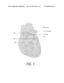 MEDICAL PROBES FOR THE TREATMENT OF BLOOD VESSELS diagram and image