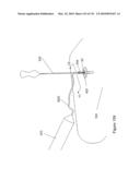 INFLATABLE MEDICAL DEVICES diagram and image