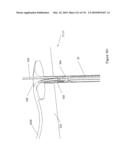 INFLATABLE MEDICAL DEVICES diagram and image