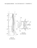 INFLATABLE MEDICAL DEVICES diagram and image