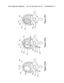 INFLATABLE MEDICAL DEVICES diagram and image