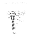 Facet Joint Replacement Instruments and Methods diagram and image