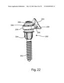 Facet Joint Replacement Instruments and Methods diagram and image