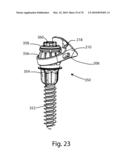 Facet Joint Replacement Instruments and Methods diagram and image