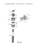 Facet Joint Replacement Instruments and Methods diagram and image