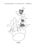 Facet Joint Replacement Instruments and Methods diagram and image