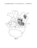 Facet Joint Replacement Instruments and Methods diagram and image