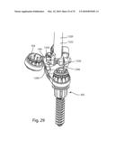 Facet Joint Replacement Instruments and Methods diagram and image