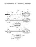 Facet Joint Replacement Instruments and Methods diagram and image