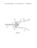 Facet Joint Replacement Instruments and Methods diagram and image