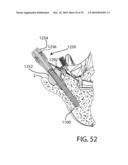 Facet Joint Replacement Instruments and Methods diagram and image