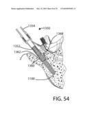 Facet Joint Replacement Instruments and Methods diagram and image