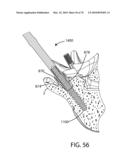 Facet Joint Replacement Instruments and Methods diagram and image