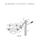 Facet Joint Replacement Instruments and Methods diagram and image