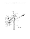 Facet Joint Replacement Instruments and Methods diagram and image