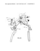 Facet Joint Replacement Instruments and Methods diagram and image