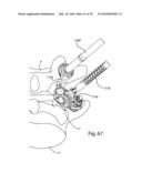 Facet Joint Replacement Instruments and Methods diagram and image