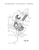 Facet Joint Replacement Instruments and Methods diagram and image