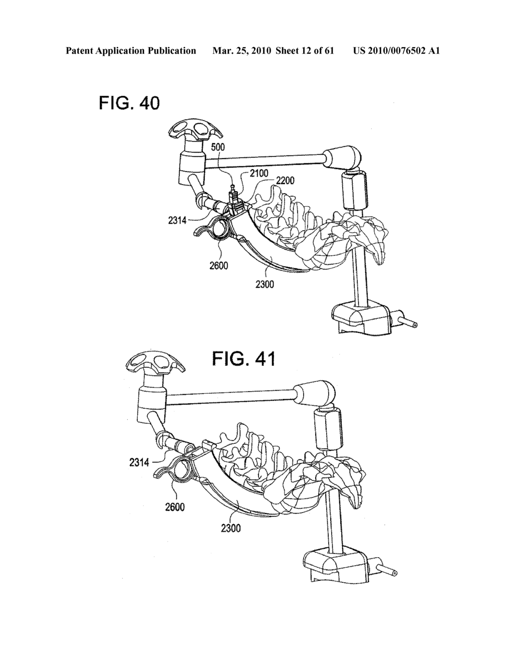 Curvilinear spinal access method and device - diagram, schematic, and image 13