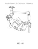 Curvilinear spinal access method and device diagram and image