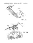 Curvilinear spinal access method and device diagram and image