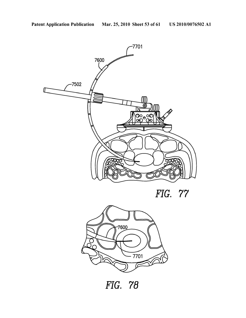 Curvilinear spinal access method and device - diagram, schematic, and image 54