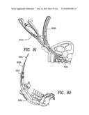 Curvilinear spinal access method and device diagram and image