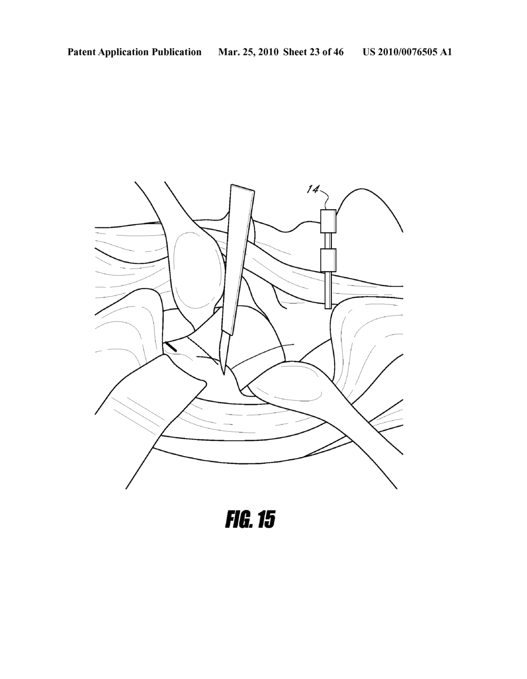 HIP SURGERY SYSTEMS AND METHODS - diagram, schematic, and image 24