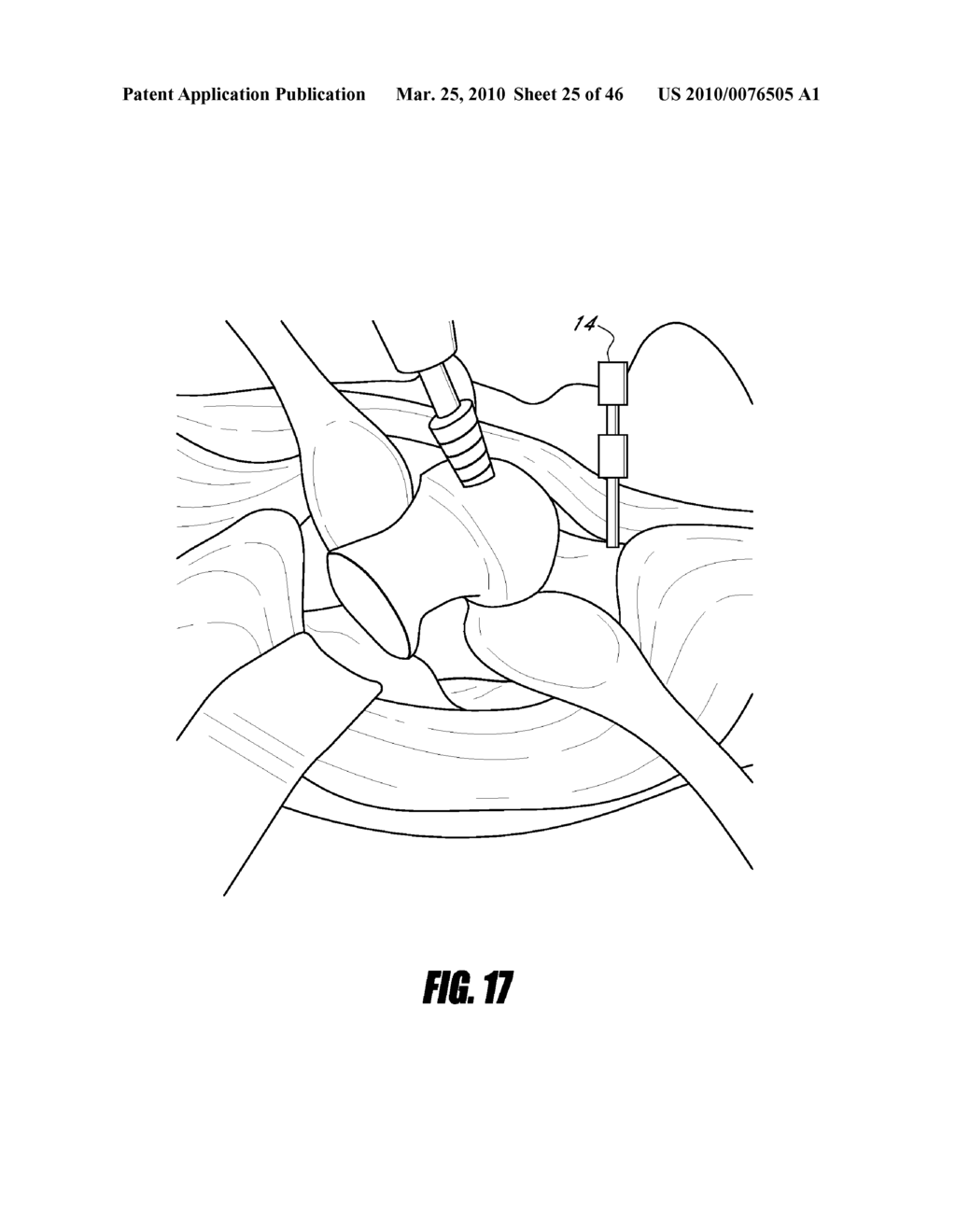 HIP SURGERY SYSTEMS AND METHODS - diagram, schematic, and image 26