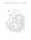 Annuloplasty Ring Configured to Receive a Percutaneous Prosthetic Heart Valve Implantation diagram and image