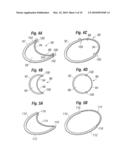 Annuloplasty Ring Configured to Receive a Percutaneous Prosthetic Heart Valve Implantation diagram and image