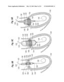 Annuloplasty Ring Configured to Receive a Percutaneous Prosthetic Heart Valve Implantation diagram and image