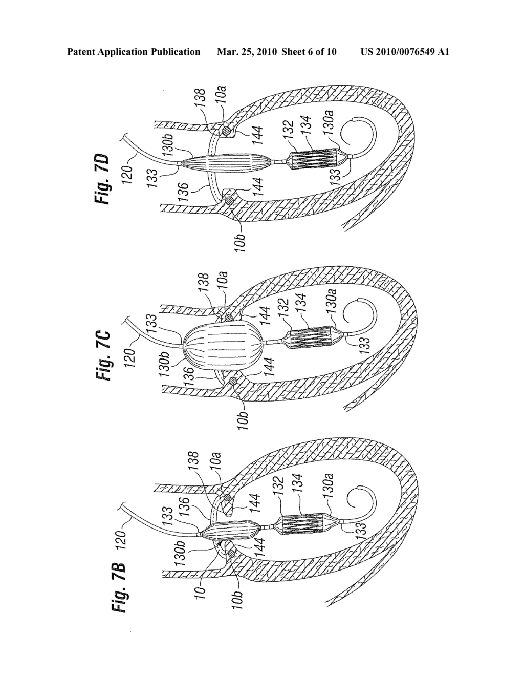 Annuloplasty Ring Configured to Receive a Percutaneous Prosthetic Heart Valve Implantation - diagram, schematic, and image 07