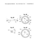 Annuloplasty Ring Configured to Receive a Percutaneous Prosthetic Heart Valve Implantation diagram and image