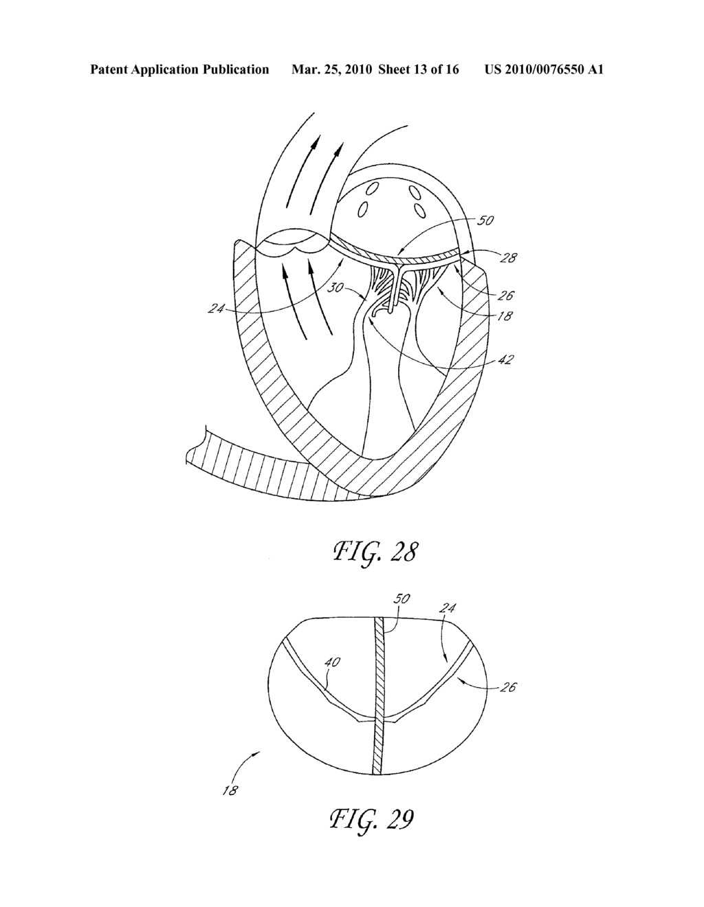 TRANSVALVULAR INTRAANNULAR BAND FOR VALVE REPAIR - diagram, schematic, and image 14