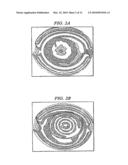 Light Adjustable Multifocal Lenses diagram and image