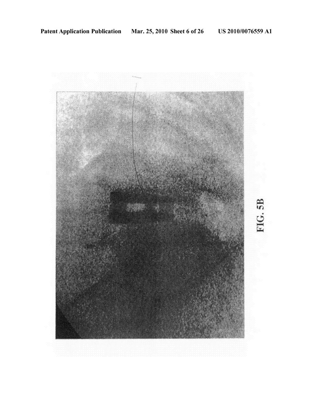 Composite telescoping anterior interbody spinal implant - diagram, schematic, and image 07