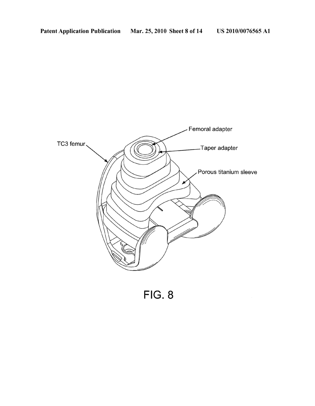 Porous Titanium Femoral Sleeves and Their Use in Revision Knee Surgery - diagram, schematic, and image 09