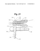 PROSTHETIC WRIST IMPLANT diagram and image