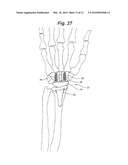 PROSTHETIC WRIST IMPLANT diagram and image