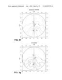 OPTHALMIC PROGRESSIVE ADDITION LENS WITH CUSTOMIZED DESIGN FEATURE diagram and image