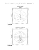 OPTHALMIC PROGRESSIVE ADDITION LENS WITH CUSTOMIZED DESIGN FEATURE diagram and image