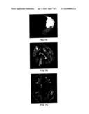 TOOLS FOR AIDING IN THE DIAGNOSIS OF NEURODEGENERATIVE DISEASES diagram and image