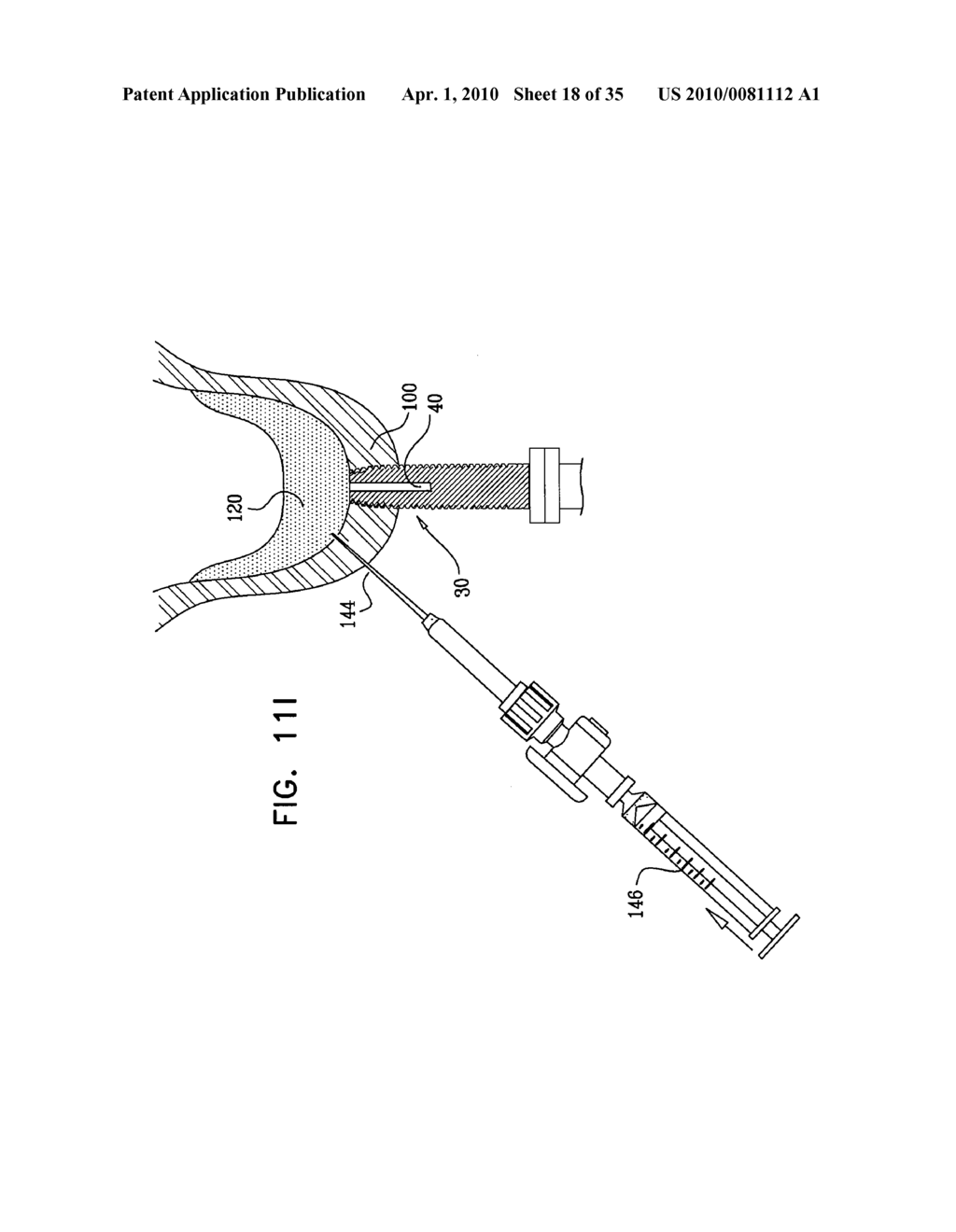 IMPLANTS, TOOLS, AND METHODS FOR SINUS LIFT AND LATERAL RIDGE AUGMENTATION - diagram, schematic, and image 19