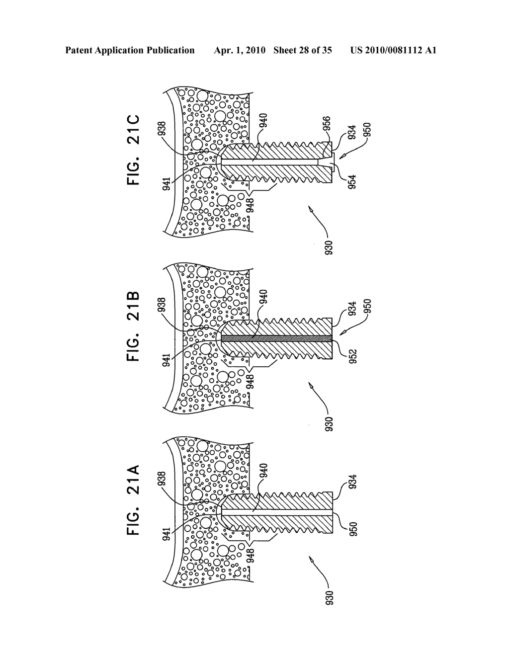 IMPLANTS, TOOLS, AND METHODS FOR SINUS LIFT AND LATERAL RIDGE AUGMENTATION - diagram, schematic, and image 29