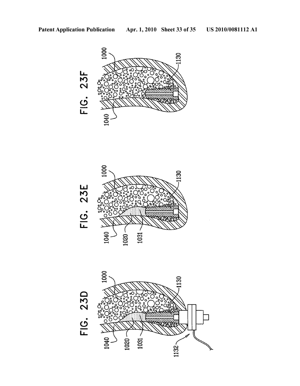 IMPLANTS, TOOLS, AND METHODS FOR SINUS LIFT AND LATERAL RIDGE AUGMENTATION - diagram, schematic, and image 34