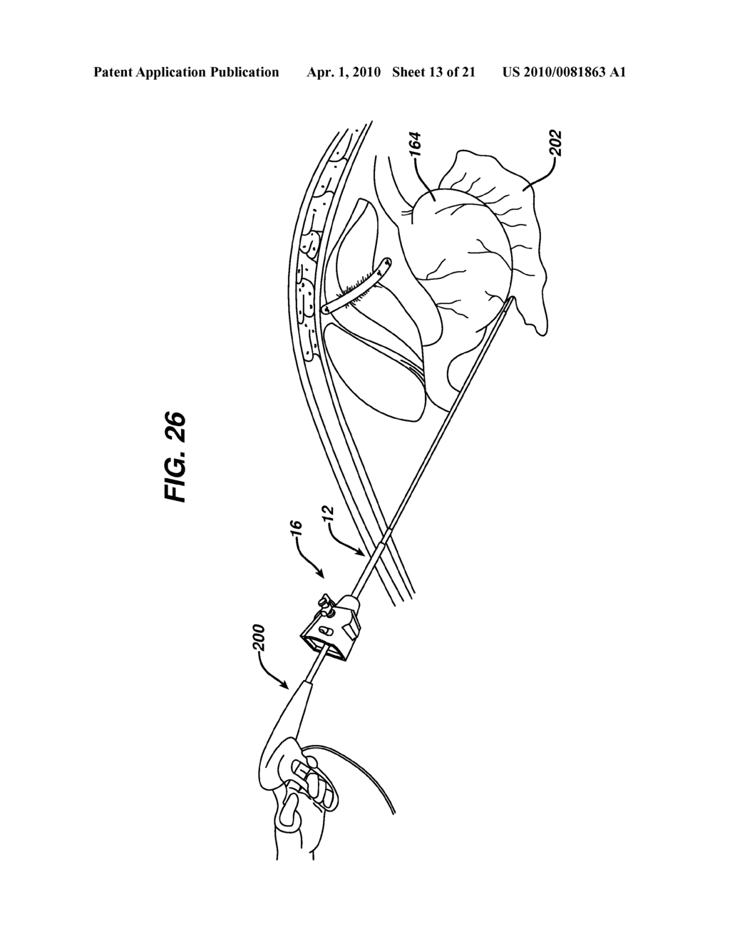 METHODS AND DEVICES FOR PERFORMING GASTRECTOMIES AND GASTROPLASTIES - diagram, schematic, and image 14