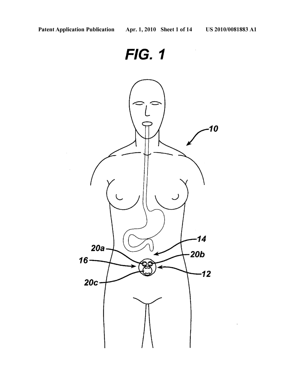 METHODS AND DEVICES FOR PERFORMING GASTROPLASTIES USING A MULTIPLE PORT ACCESS DEVICE - diagram, schematic, and image 02