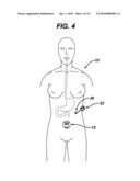 METHODS AND DEVICES FOR PERFORMING GASTROPLASTIES USING A MULTIPLE PORT ACCESS DEVICE diagram and image