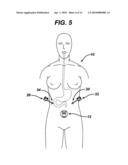 METHODS AND DEVICES FOR PERFORMING GASTROPLASTIES USING A MULTIPLE PORT ACCESS DEVICE diagram and image